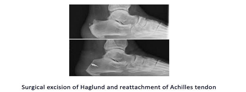 Haglunds Deformity Foot Ankle